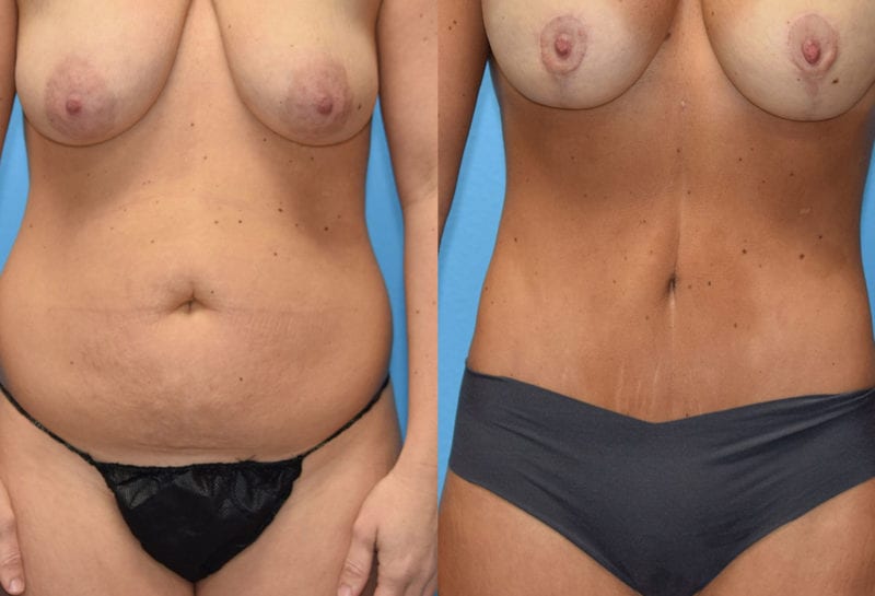 Tummy tuck results by Dr. Maningas at Maningas Cosmetic Surgery in Joplin, MO