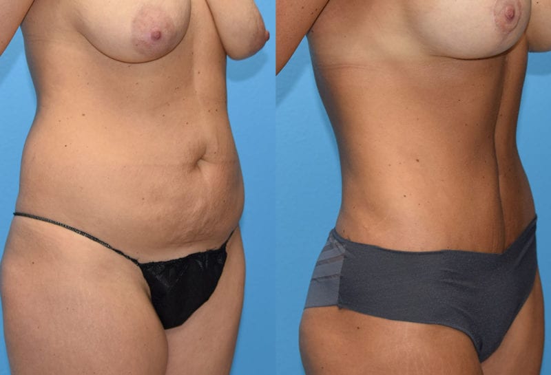 Tummy tuck results by Dr. Maningas at Maningas Cosmetic Surgery in Joplin, MO