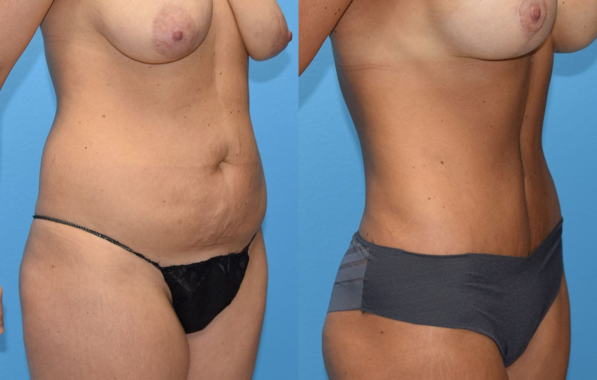 Tummy tuck results by Dr. Maningas at Maningas Cosmetic Surgery in Joplin, MO