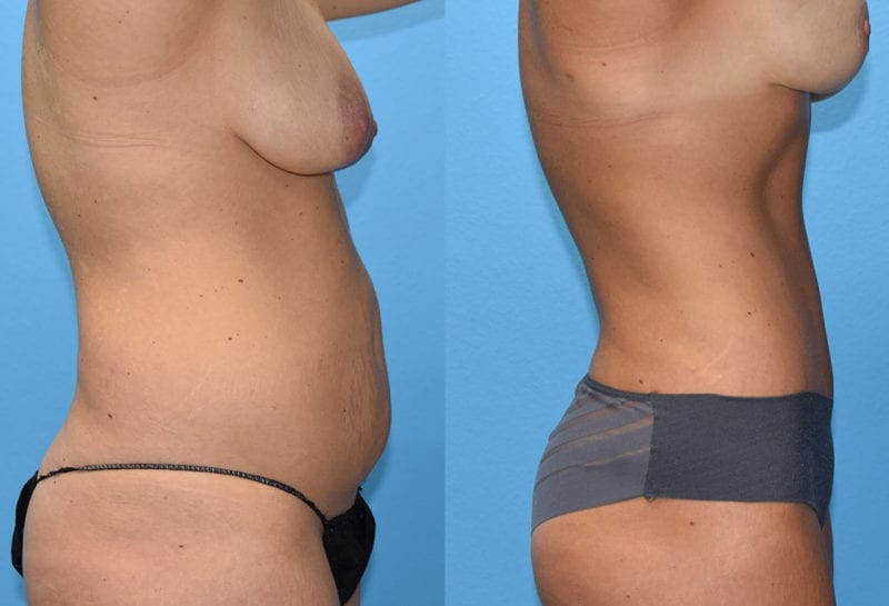 Tummy tuck results by Dr. Maningas at Maningas Cosmetic Surgery in Joplin, MO