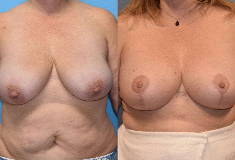 Breast Lift with Implant results by Dr. Maningas at Maningas Cosmetic Surgery in Missouri and Arkansas