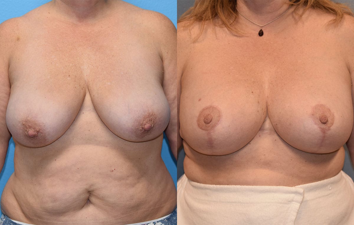 Breast Lift with Implant results by Dr. Maningas at Maningas Cosmetic Surgery in Missouri and Arkansas