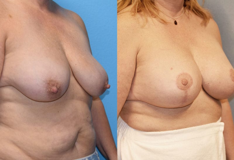 Breast Lift with Implant results by Dr. Maningas at Maningas Cosmetic Surgery in Missouri and Arkansas