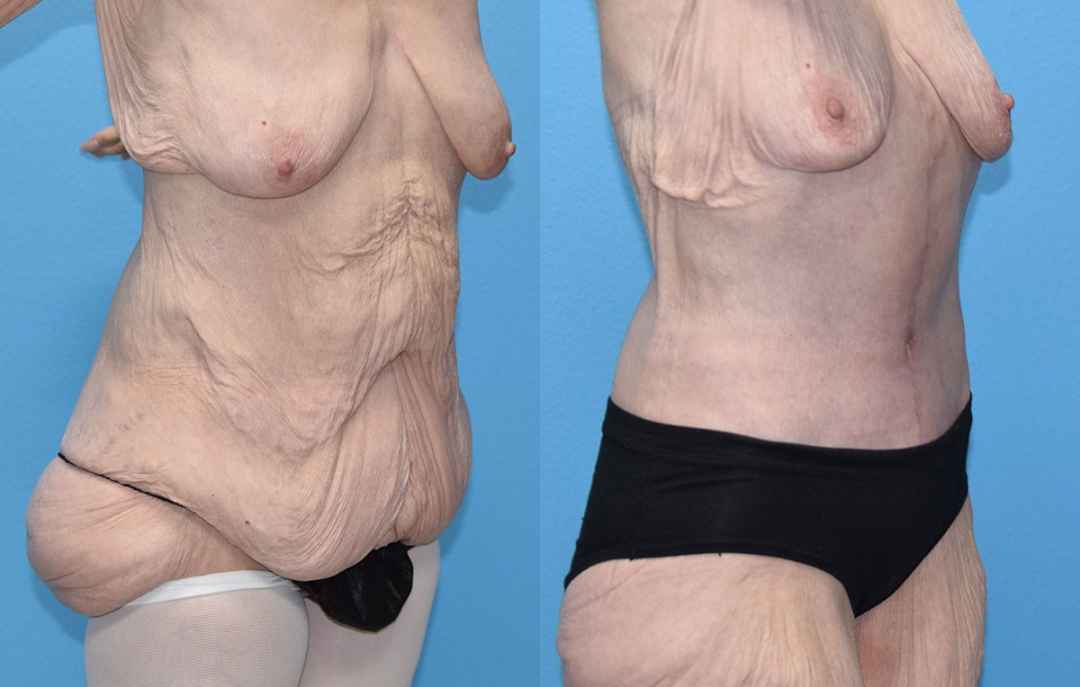 Tummy tuck results by Dr. Maningas at Maningas Cosmetic Surgery in Joplin, MO