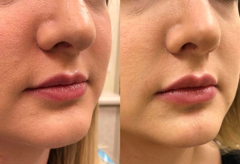 Lip Filler in Joplin, MO at Maningas Cosmetics Surgery