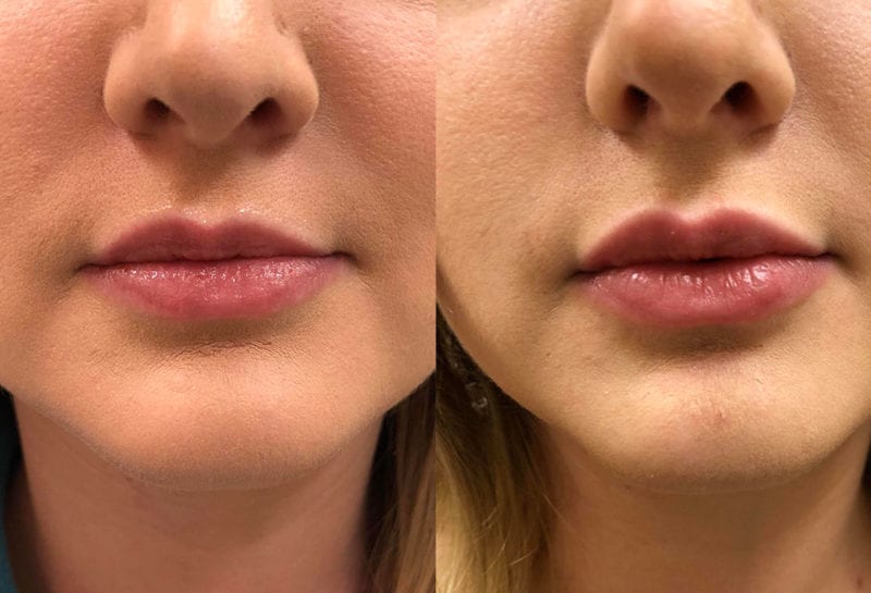 Lip Filler in Joplin, MO at Maningas Cosmetics Surgery