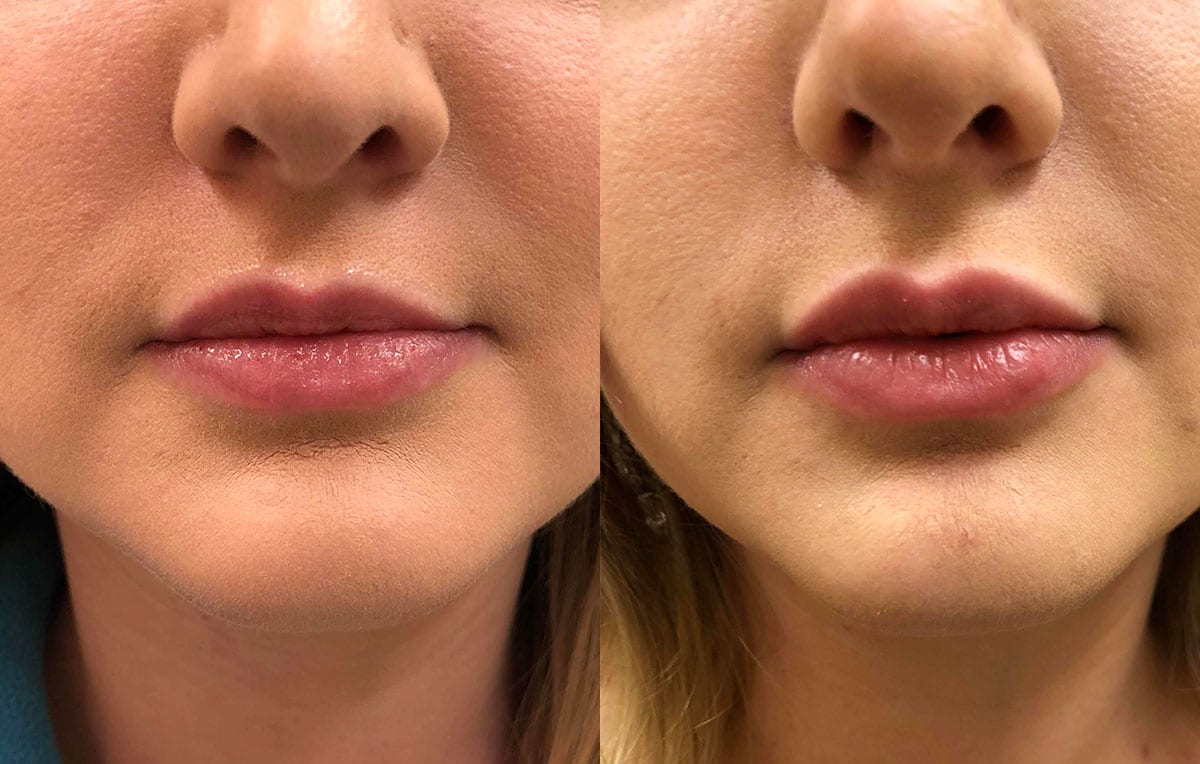 Lip Filler in Joplin, MO at Maningas Cosmetics Surgery