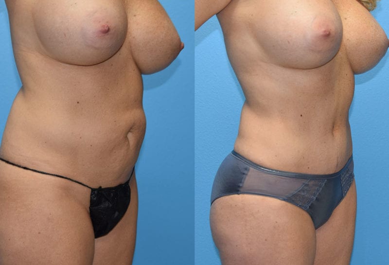 Tummy tuck results by Dr. Maningas at Maningas Cosmetic Surgery in Joplin, MO