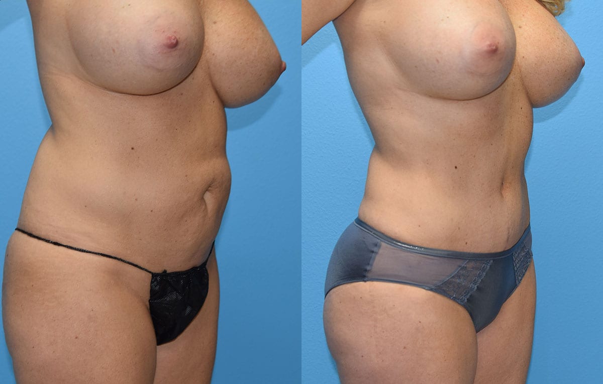 Tummy tuck results by Dr. Maningas at Maningas Cosmetic Surgery in Joplin, MO