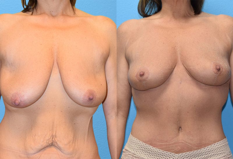 breast reduction results by Dr. Maningas as Maningas Cosmetic Surgery