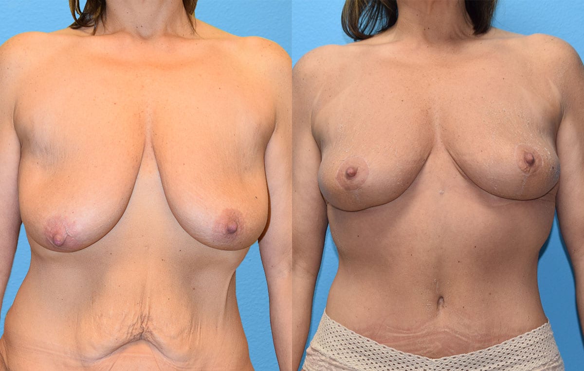 breast reduction results by Dr. Maningas as Maningas Cosmetic Surgery