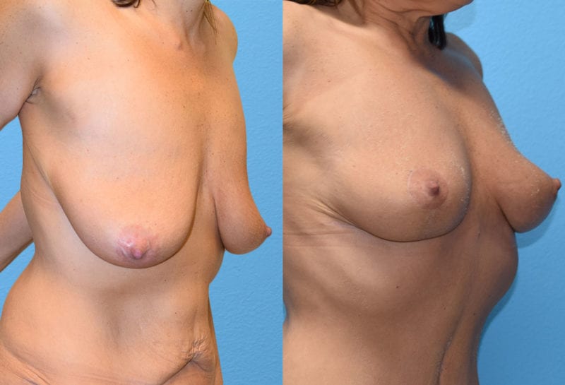 breast reduction results by Dr. Maningas as Maningas Cosmetic Surgery