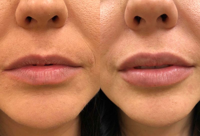 Lip Filler in Joplin, MO at Maningas Cosmetics Surgery