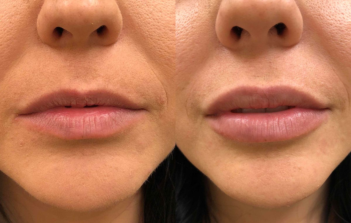 Lip Filler in Joplin, MO at Maningas Cosmetics Surgery