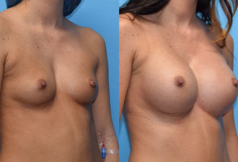 breast augmentation results by dr. maningas at maningas cosmetic surgery in joplin, mo