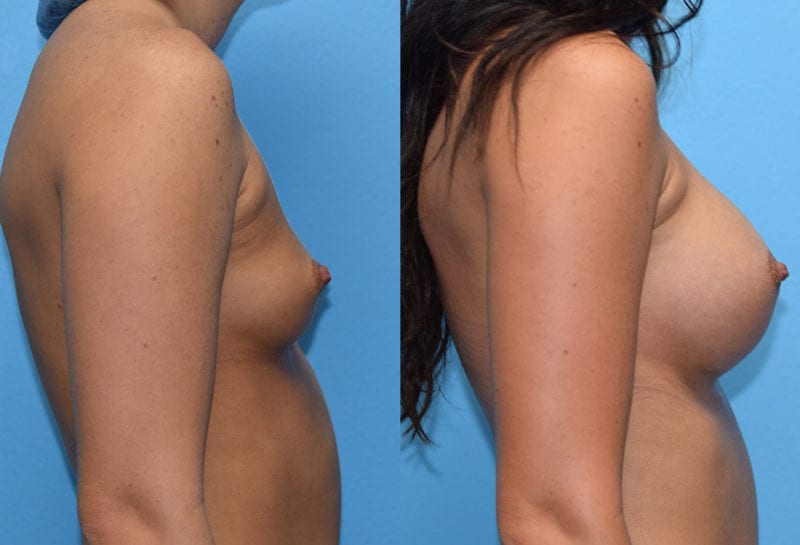 breast augmentation results by dr. maningas at maningas cosmetic surgery in joplin, mo