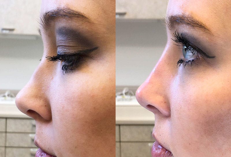 Liquid Rhinoplasty results at Maningas Cosmetic Surgery in Joplin, MO