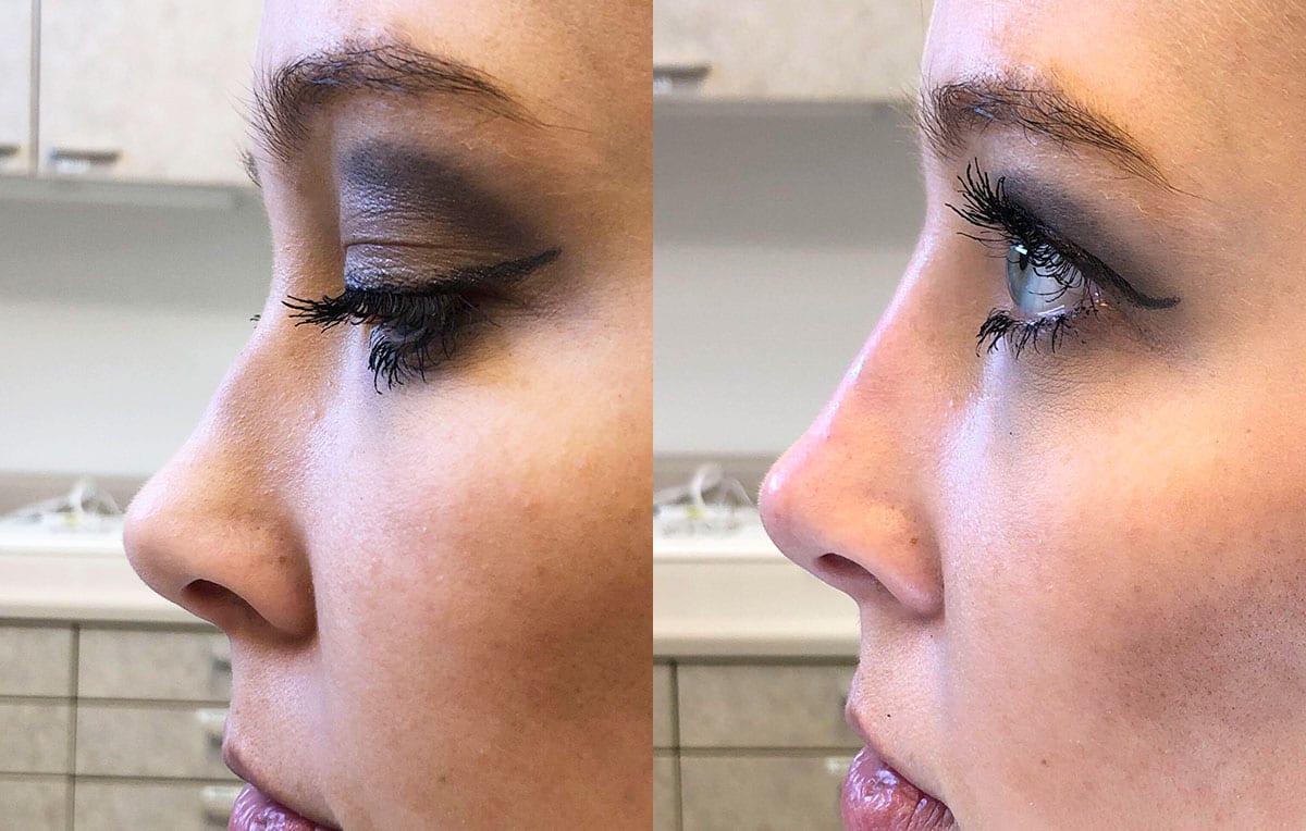 Liquid Rhinoplasty results at Maningas Cosmetic Surgery in Joplin, MO