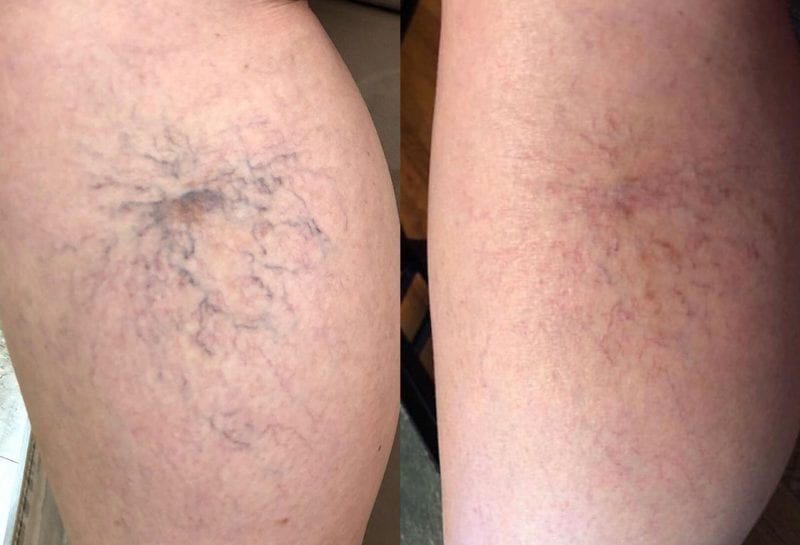 Sclerotherapy, or sider vein treatment, in Joplin, MO at Maningas Cosmetic Surgery to permanently remove small to medium sized leg spider veins