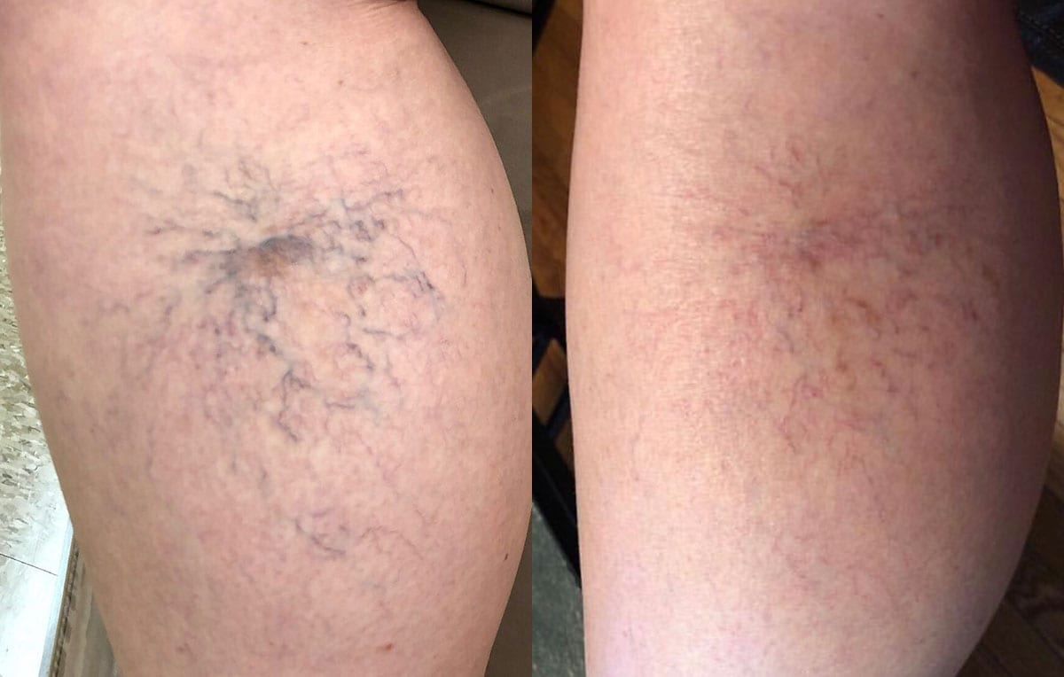 Sclerotherapy, or sider vein treatment, in Joplin, MO at Maningas Cosmetic Surgery to permanently remove small to medium sized leg spider veins