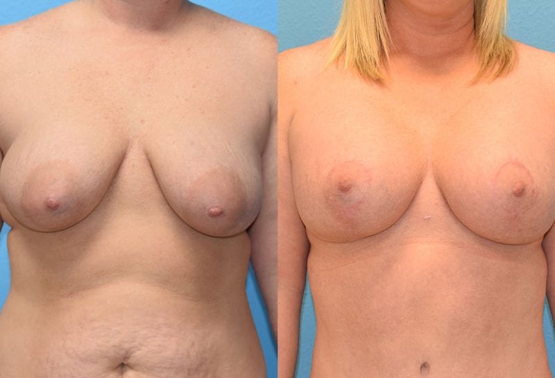 Breast Lift with Implant results by Dr. Maningas at Maningas Cosmetic Surgery in Missouri and Arkansas