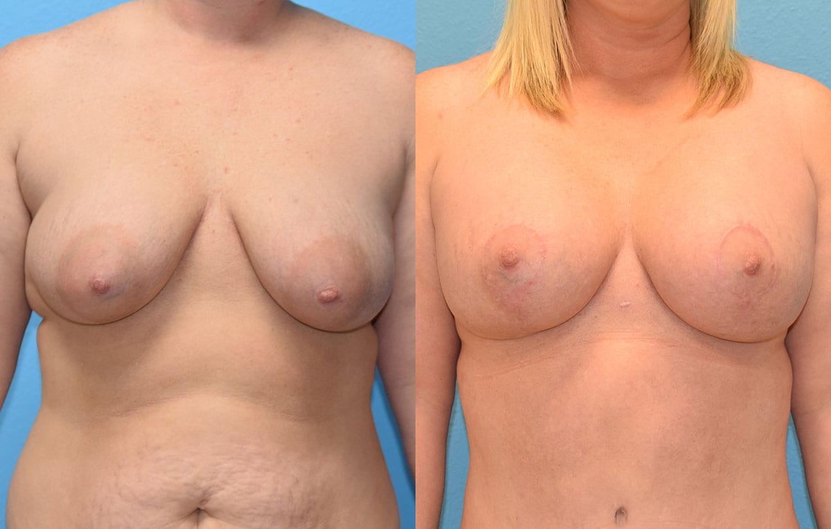 Breast Lift with Implant results by Dr. Maningas at Maningas Cosmetic Surgery in Missouri and Arkansas