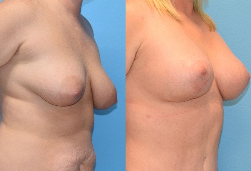 Breast Lift with Implant results by Dr. Maningas at Maningas Cosmetic Surgery in Missouri and Arkansas