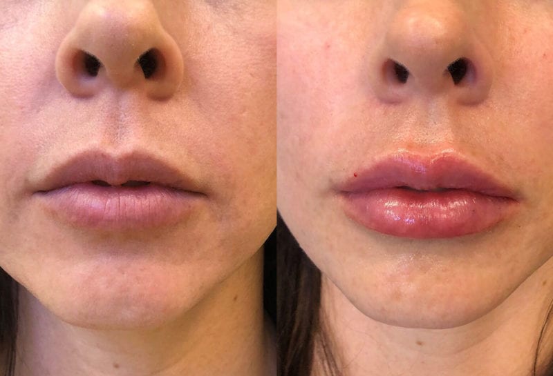 Lip Filler in Joplin, MO at Maningas Cosmetics Surgery