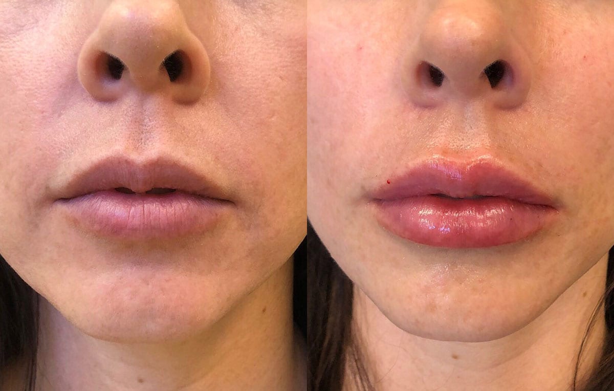 Lip Filler in Joplin, MO at Maningas Cosmetics Surgery