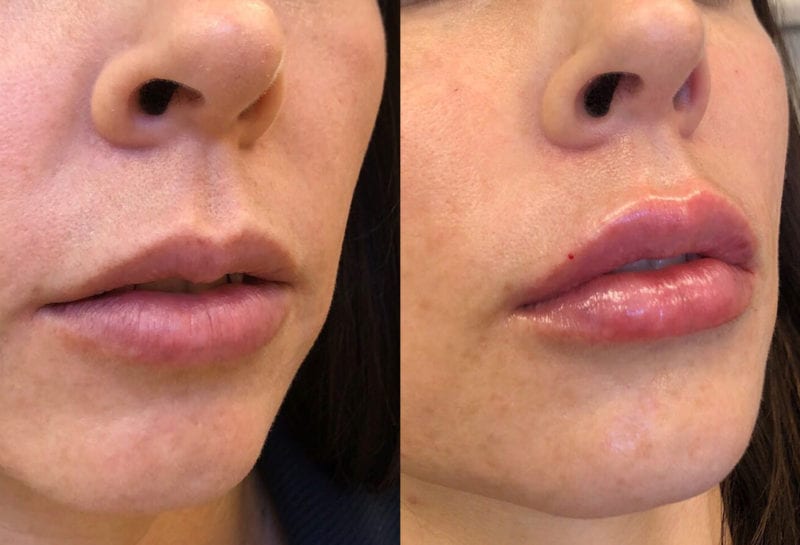 Lip Filler in Joplin, MO at Maningas Cosmetics Surgery