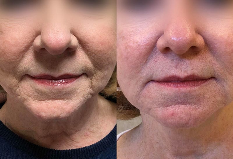 Lower Mouth Filler Results at Maningas Cosmetic Surgery in Joplin, MO