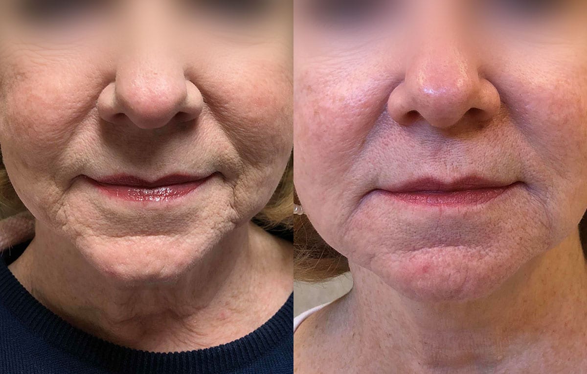 Lower Mouth Filler Results at Maningas Cosmetic Surgery in Joplin, MO