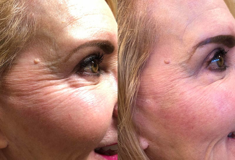 Cheek filler results at Maningas Cosmetic Surgery in Joplin, MO