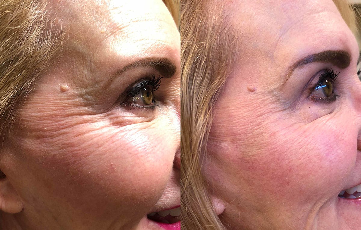 Cheek filler results at Maningas Cosmetic Surgery in Joplin, MO