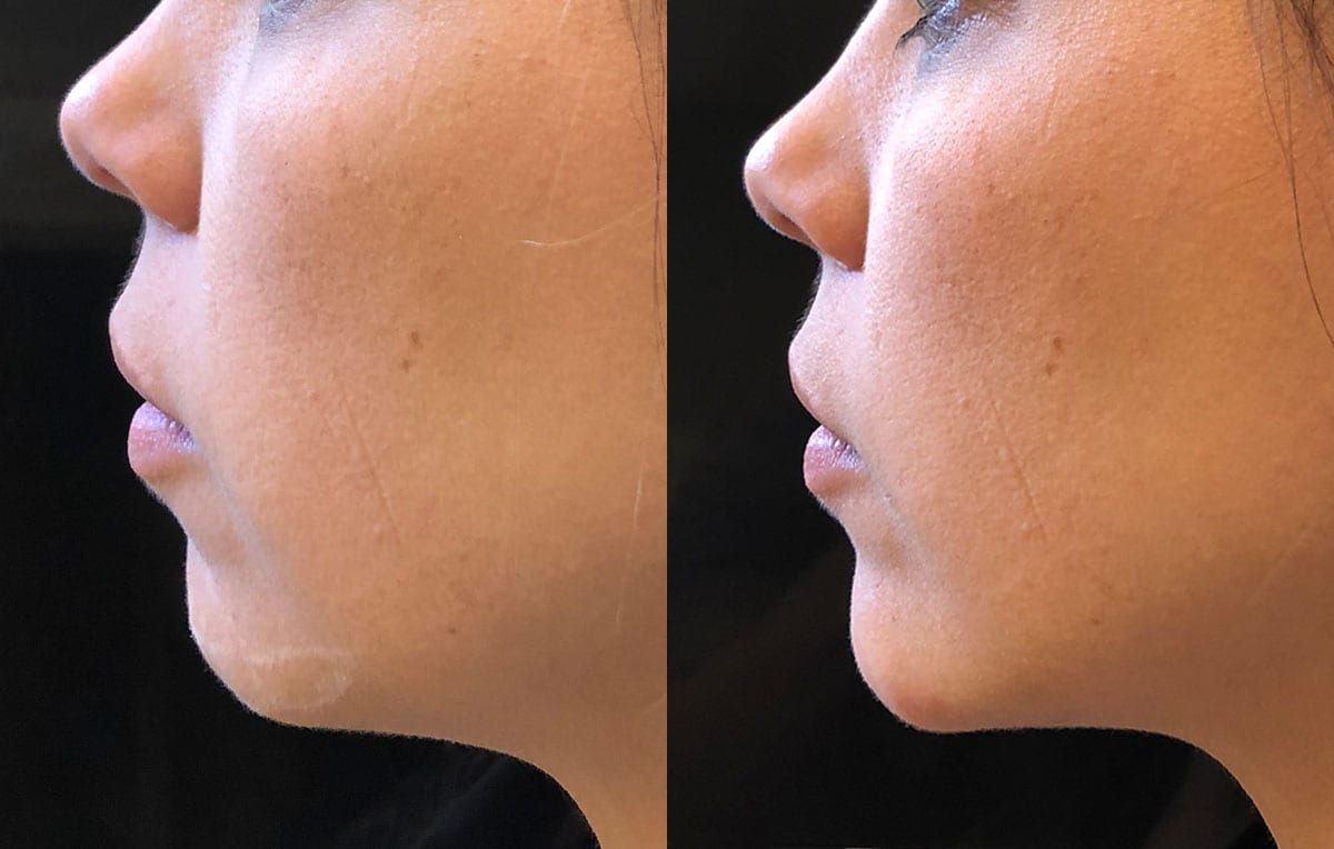 Chin filler results at Maningas Cosmetic Surgery in Joplin, MO