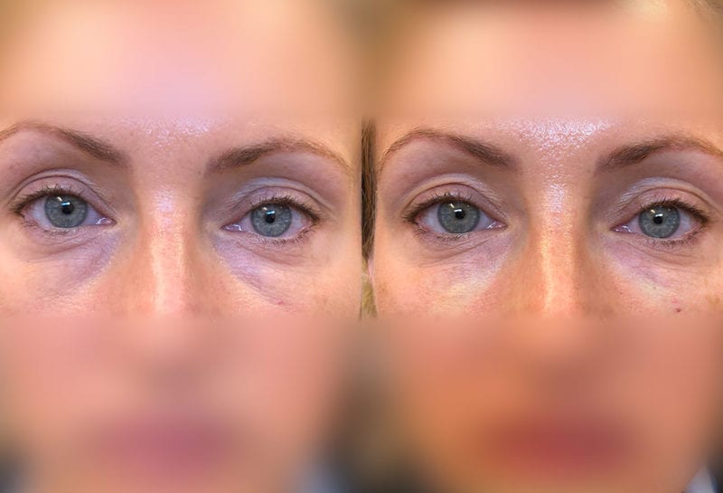 Tear Trough, Lower Lid, Filler Results at Maningas Cosmetic Surgery in Joplin, MO