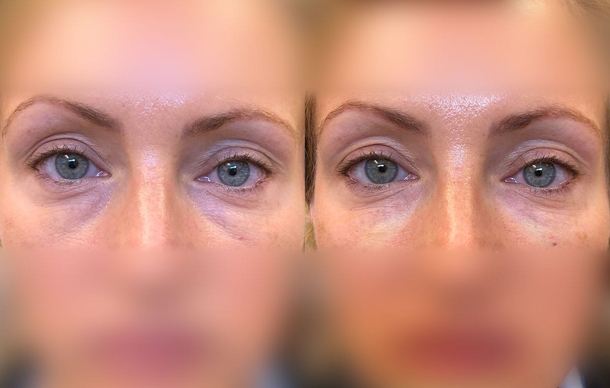 Tear Trough, Lower Lid, Filler Results at Maningas Cosmetic Surgery in Joplin, MO