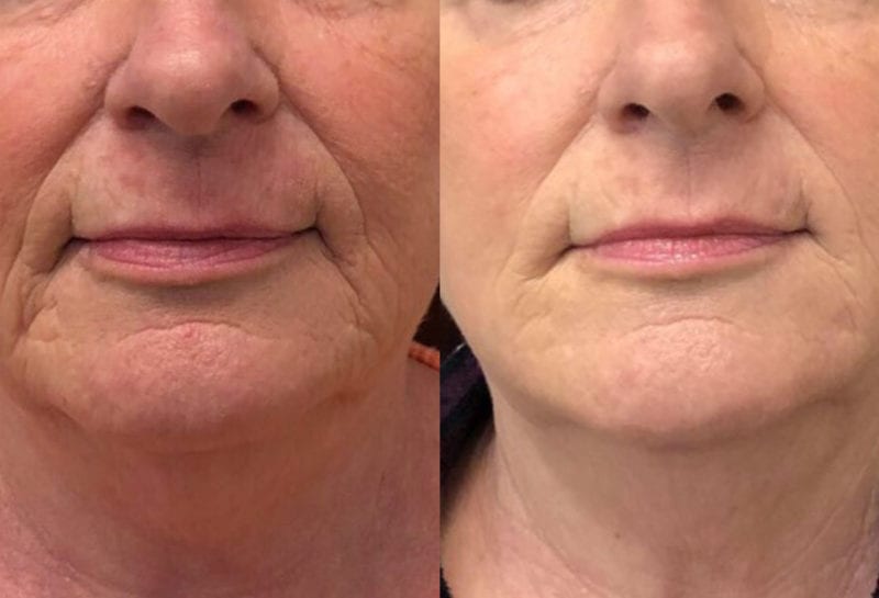 Lower Mouth Filler Results at Maningas Cosmetic Surgery in Joplin, MO