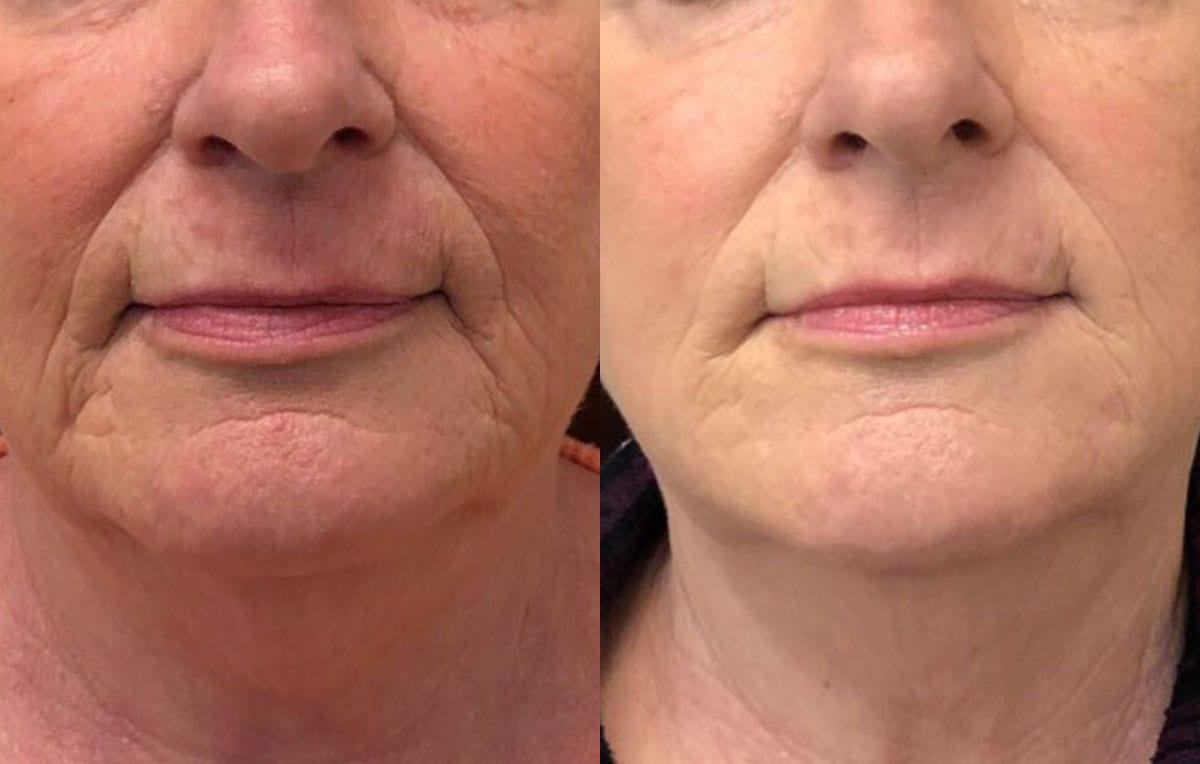 Lower Mouth Filler Results at Maningas Cosmetic Surgery in Joplin, MO