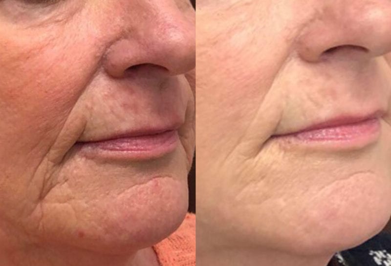 Lower Mouth Filler Results at Maningas Cosmetic Surgery in Joplin, MO