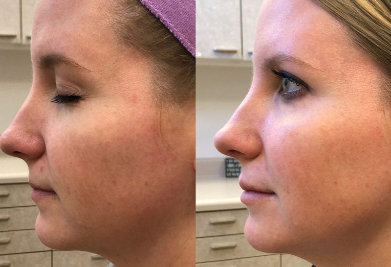 Cheek filler results at Maningas Cosmetic Surgery in Joplin, MO