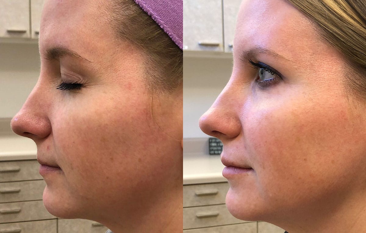 Cheek filler results at Maningas Cosmetic Surgery in Joplin, MO