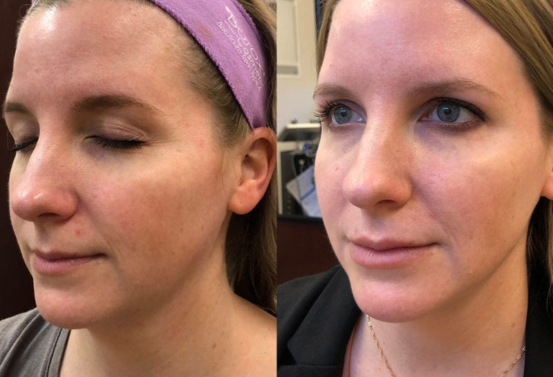 Cheek filler results at Maningas Cosmetic Surgery in Joplin, MO