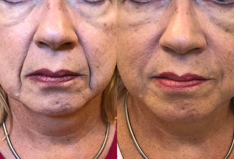 Lower Mouth Filler Results at Maningas Cosmetic Surgery in Joplin, MO