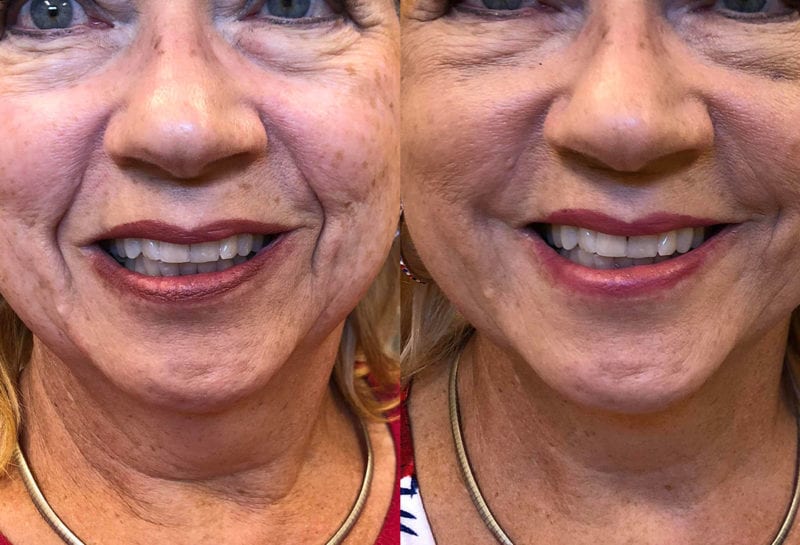 Lower Mouth Filler Results at Maningas Cosmetic Surgery in Joplin, MO