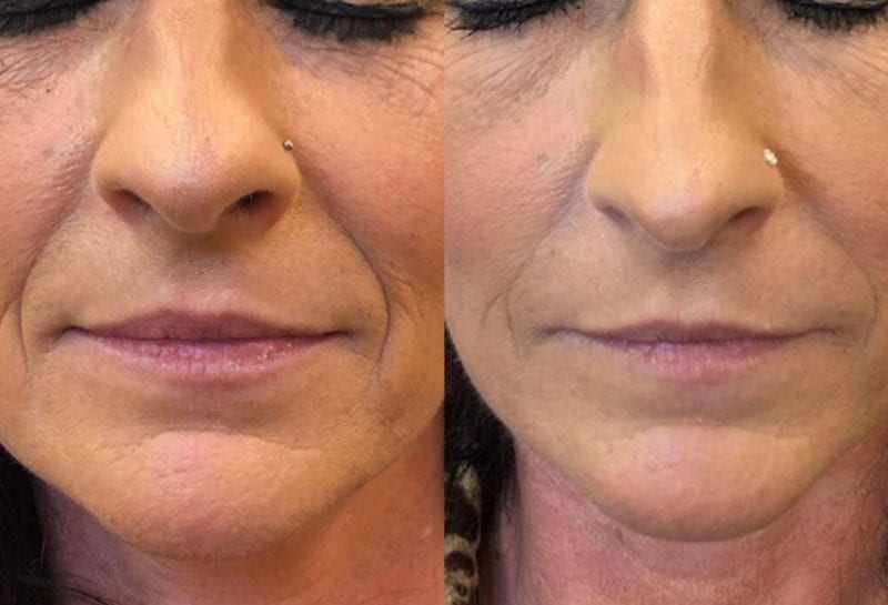 Lower Mouth Filler Results at Maningas Cosmetic Surgery in Joplin, MO