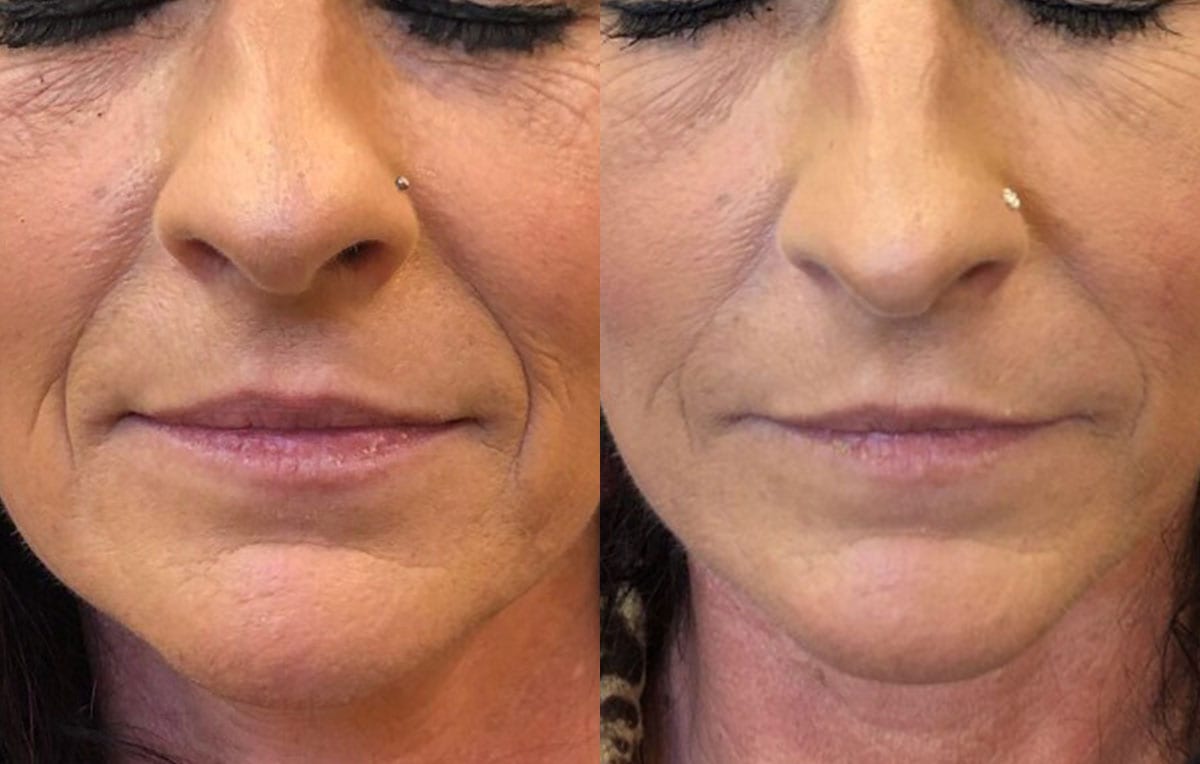 Lower Mouth Filler Results at Maningas Cosmetic Surgery in Joplin, MO