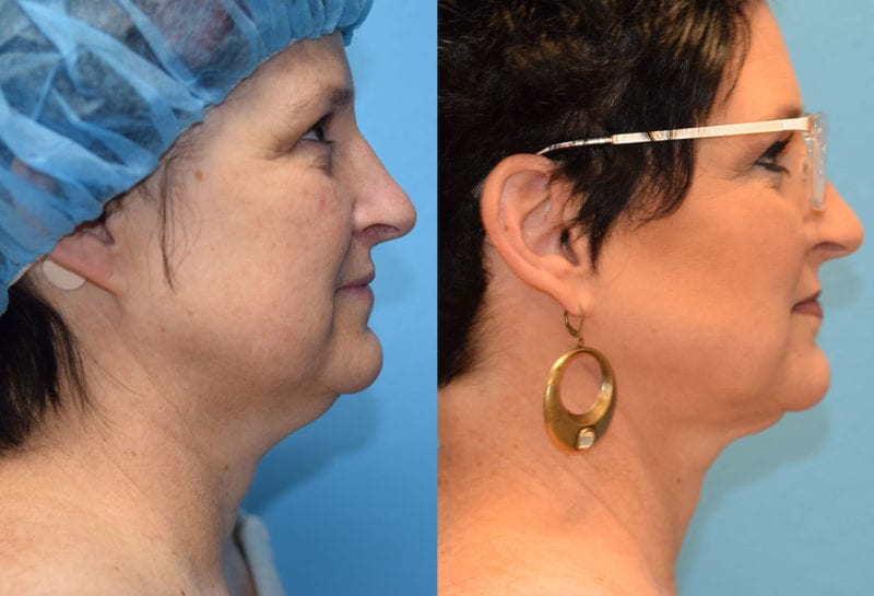 Facetite and Morpheus8, aka EmbraceRF, 4 month results at Maningas Cosmetic Surgery in Joplin, MO.