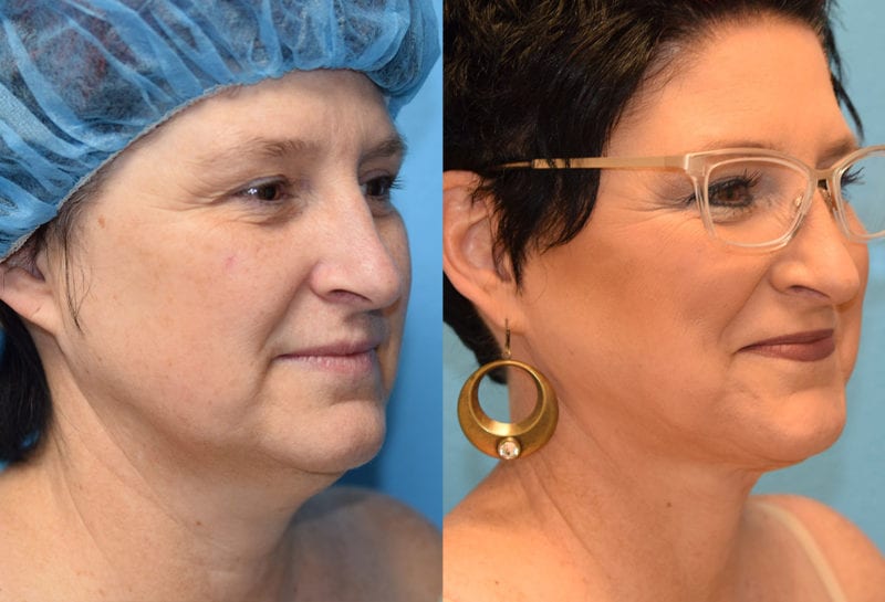 Facetite and Morpheus8, aka EmbraceRF, 4 month results at Maningas Cosmetic Surgery in Joplin, MO.