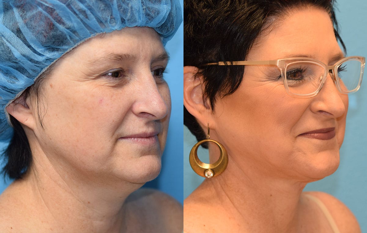 Facetite and Morpheus8, aka EmbraceRF, 4 month results at Maningas Cosmetic Surgery in Joplin, MO.